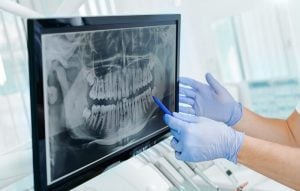 A dentist in blue gloves pointing to a dental x-ray on the screen