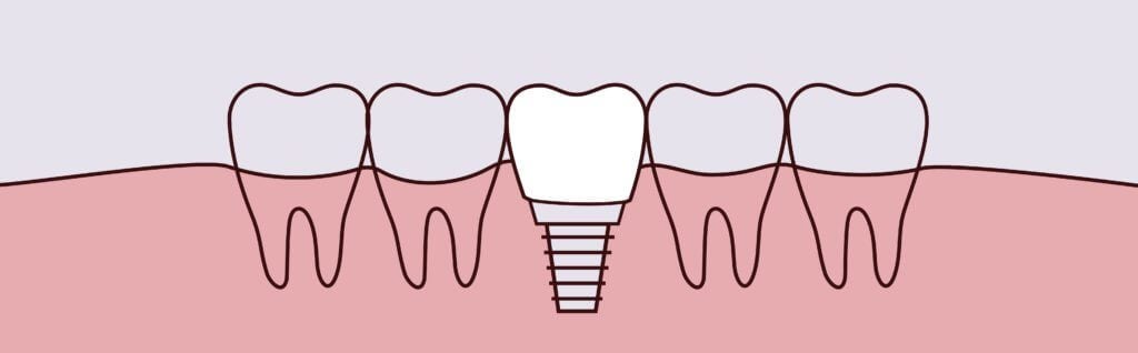 dental implants Colfax